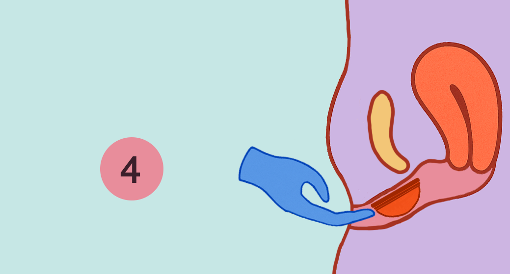 Illustration of a hand putting an umi menstrual disc into a diagram of a womans vaginal canal.