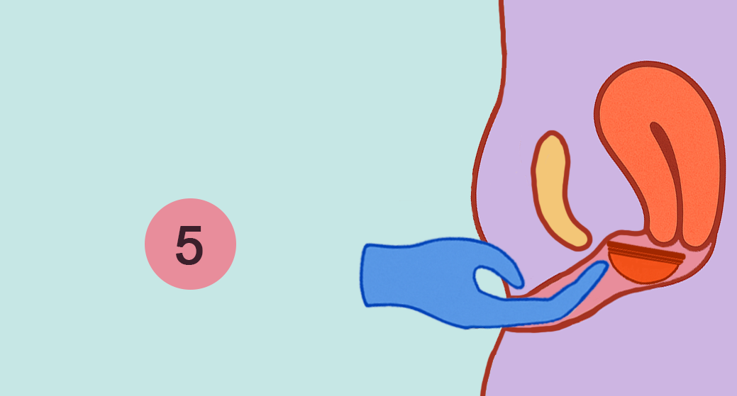 Illustration of a hand tucking an umi menstrual disc behind a womans pubic bone.