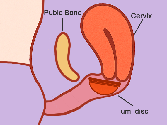 Diagram of female reproductive system with labeled pubic bone, cervix, and 'umi disc'.